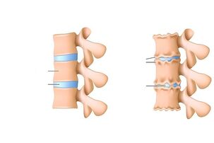Osteocondritis of the spine
