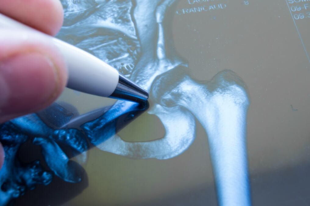 Osteoarthritis of the hip joint on the x-ray