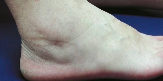 ankle swelling with osteoarthritis