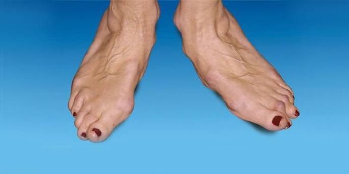 deformity of the foot with osteoarthritis of the ankle