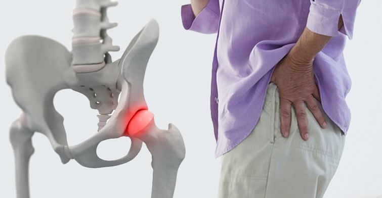 pain in the hip area - a symptom of osteoarthritis of the hip joint