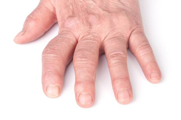 deforming osteoarthritis of the hands