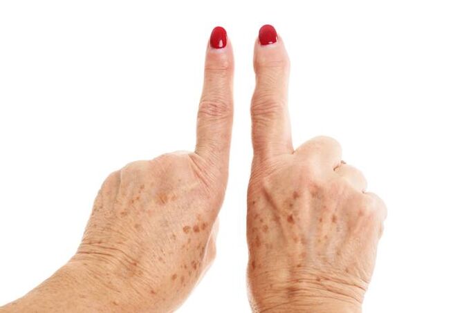 deforming osteoarthritis on the fingers