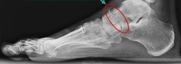 ankle arthritis scintigraphy