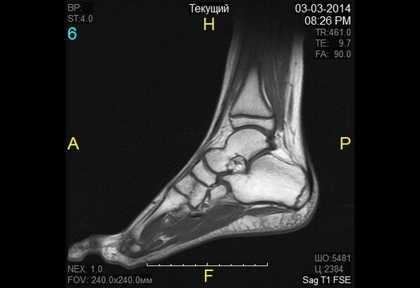 ankle picture for osteoarthritis