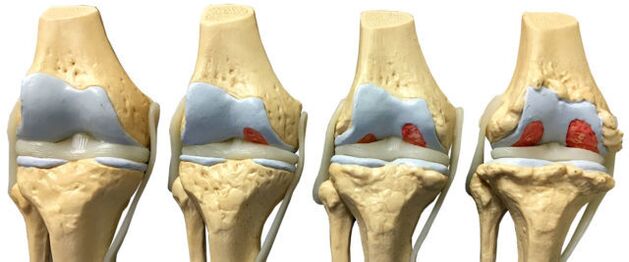 joint damage at different stages of development of osteoarthritis of the ankle