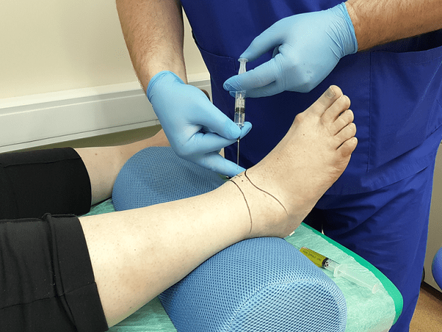 puncture for osteoarthritis of the ankle joint