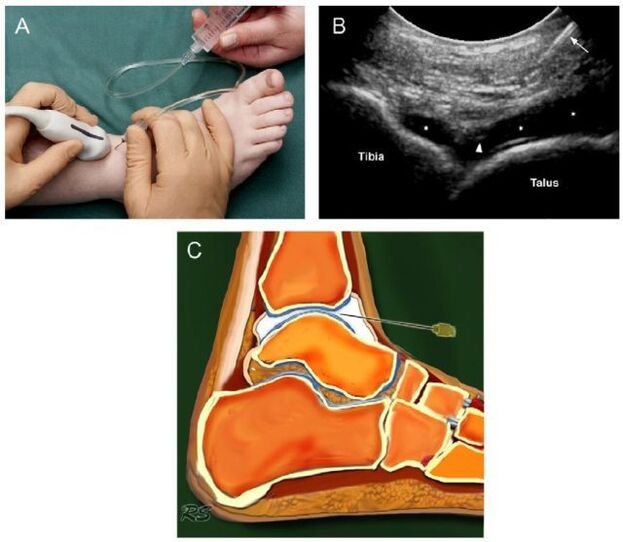 ultrasound of the ankle joint with osteoarthritis