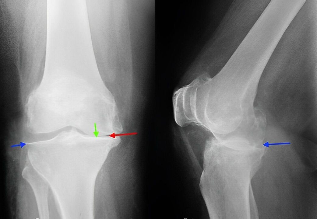 x-ray of osteoarthritis of the knee joint