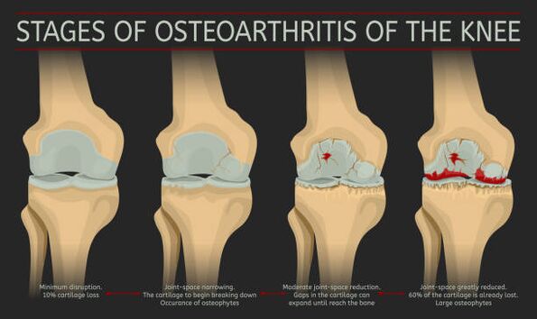 development of joint osteoarthritis