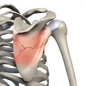 A broken shoulder blade is one of the causes of severe pain.