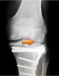 osteoarthritis of the knee joint